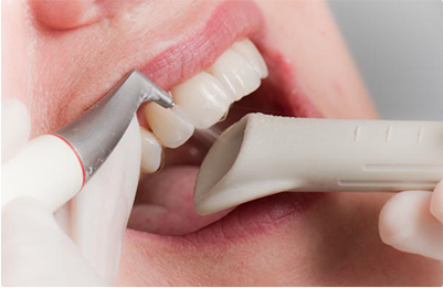 Отбеливание зубов: особенности чистки Air Flow