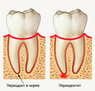 Симптомы периодонтита