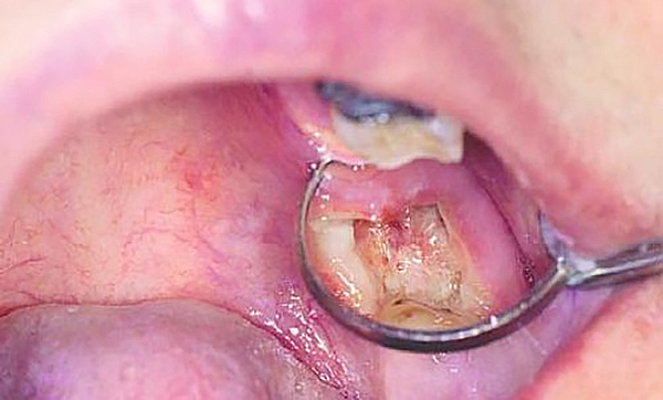 Альвеолит после удаления зуба