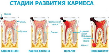Какой бывает кариес