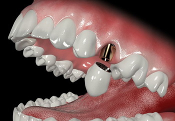 Коронка на зубной имплант
