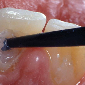 Эндодонтическое отбеливание зуба