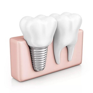 Какую имплантацию зубов выбрать: классическую или сразу после удаления?