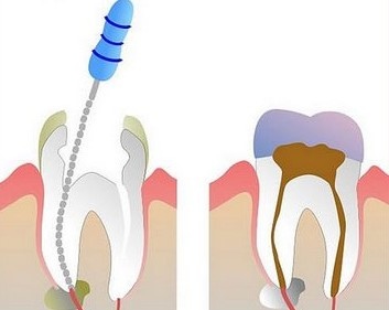 Чистка зубных каналов