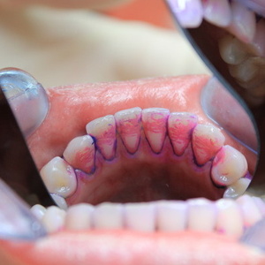 Как можно определить качество чистки зубов