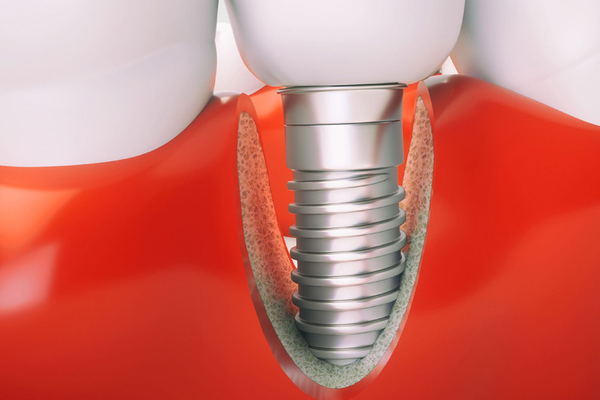 Отторжение зубного импланта