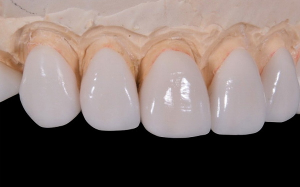 Безметалловая керамика в стоматологии