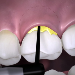 Опасное стоматологическое заболевание периодонтит