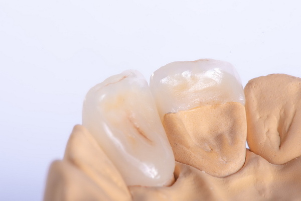 Керамические зубные вкладки