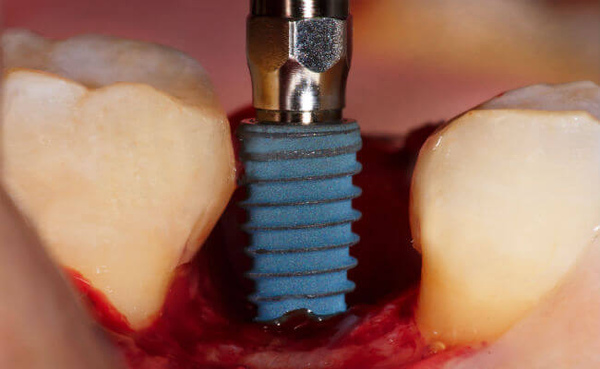 Как вставляют зуб? Насколькоболезненна данная процедура?