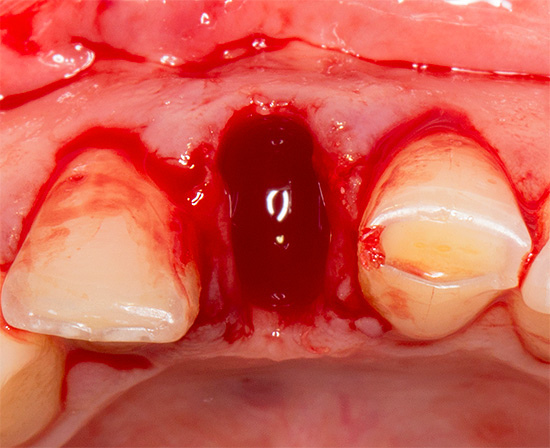 Кровотечение после удаления восьмого зуба