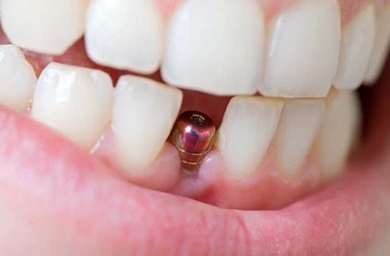 Сколько может прослужить имплантация зубов