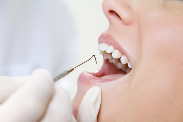 Причины, по которым выпадает пломба из зуба
