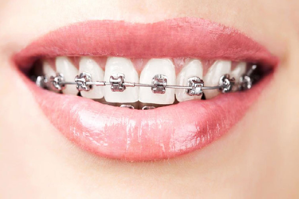 Профилактика стоматологических заболеваний при ортодонтическом лечении