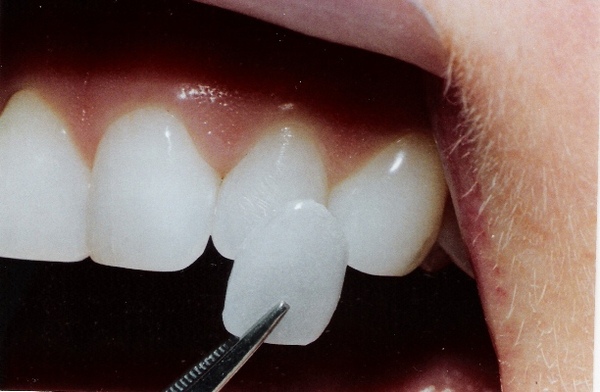 Восстановление зуба виниром