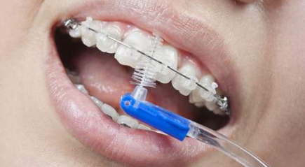 Выбор средств для гигиены полости рта при установленных брекетах