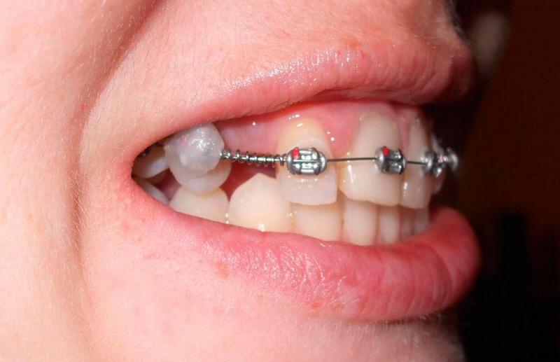 Защитный воск для брекетов - Стоматология «НоваДэнт»