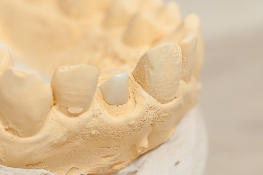 Что такое культевая вкладка под коронку - Стоматология «НоваДэнт»