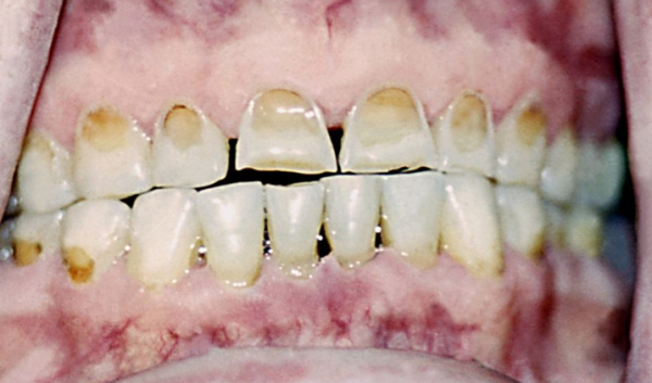 Некроз твердых тканей зуба - Стоматология «НоваДэнт»