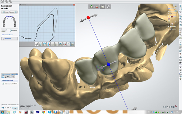 Протезирование системой CAD/CAM - Стоматология «НоваДэнт»