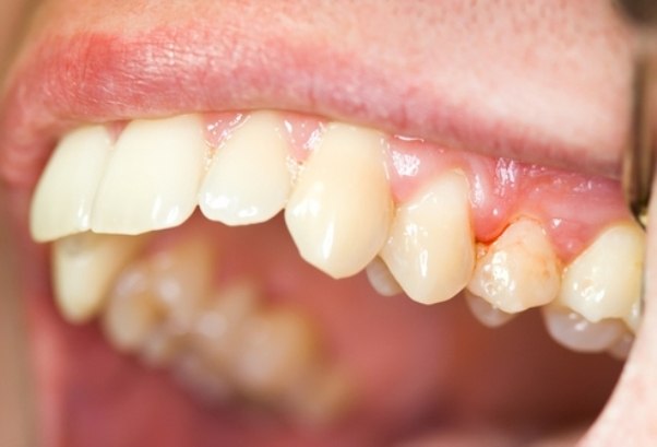 Периодонтит зуба (симптомы,причины, лечение) - Стоматология «НоваДэнт»